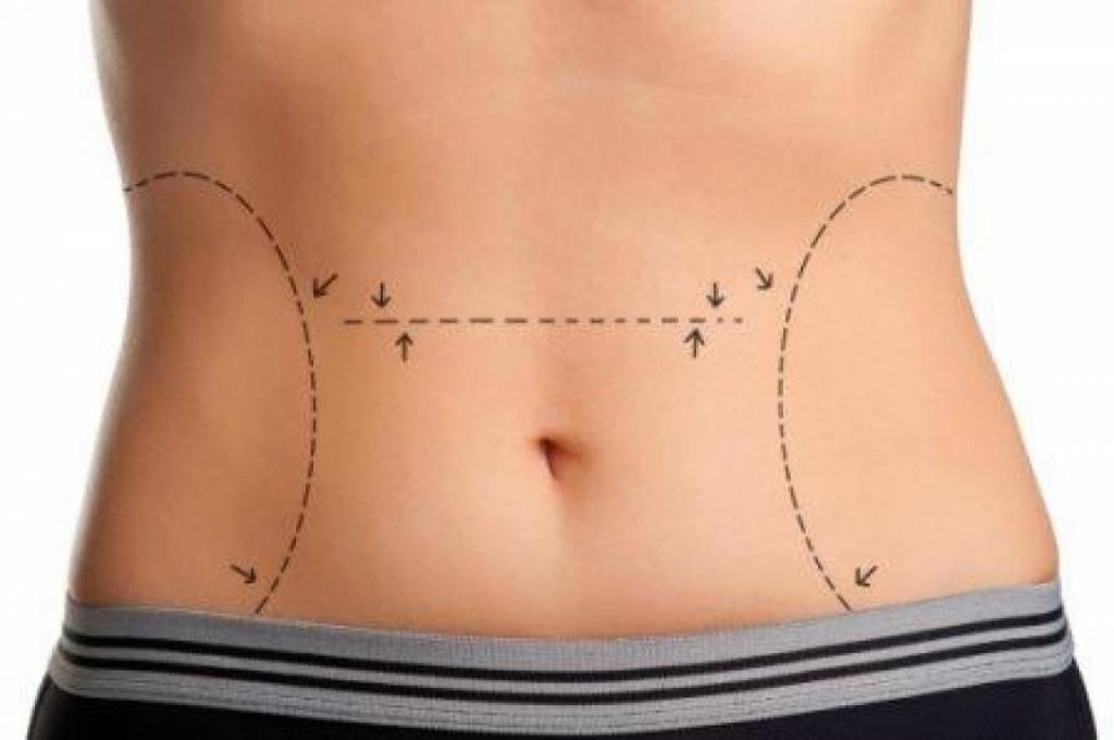 Entenda o que é a Abdominoplastia